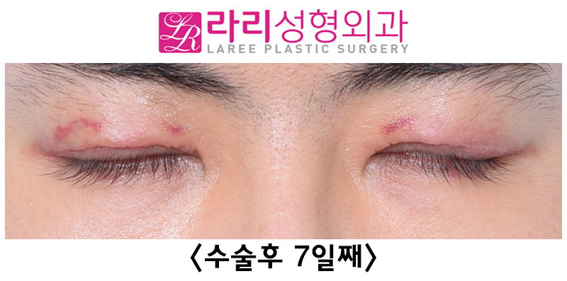 [라리성형외과] 쌍꺼풀없애기 수술 눈안감김(토안)의 원인이 정말 피부절제 때문일까? - 무절제쌍꺼풀없애기 관련 이미지 12