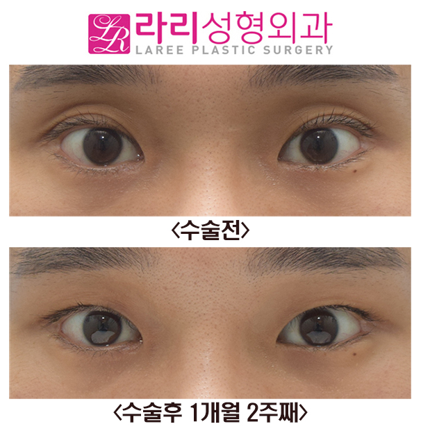 [Lari Plastic Surgery] Sunken Upper Eyelid Fat Grafting + Double Eyelid Removal Before and After Surgery image 2