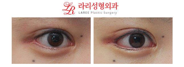 Before-and-After Photos of Micro Outer Canthoplasty with Lowering of the Outer Eye Corner☆ image 3