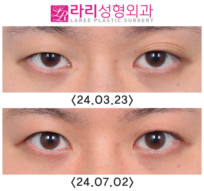[라리성형외과] 쌍꺼풀없애는수술 후 필요에 의한 재교정과 회복 과정 기간별 사진 관련 이미지 7