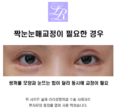 Where Is a Good Place for Eye Correction for Uneven Eyes? image 1
