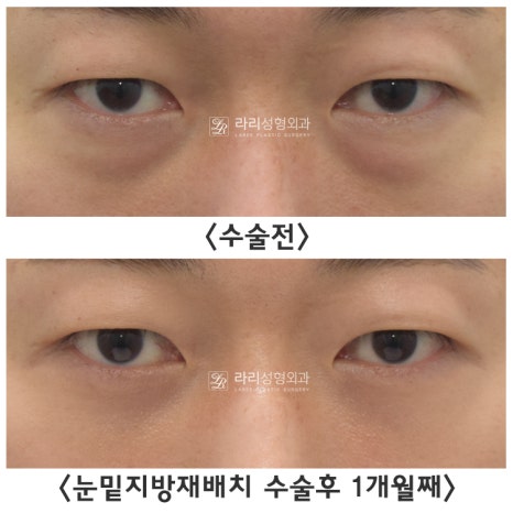 [라리성형외과] 하안검성형 VS 눈밑지방재배치(제거) : 어떤 수술을 해야 할까? 관련 이미지 7