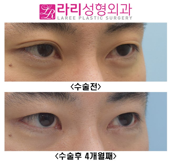 [라리성형외과] 쌍꺼풀없애는수술+ 트임없는앞트임수술+ 눈꼬리내리기뒤트임수술 = 또렷한 눈, 남자다운 눈, 멋있는 눈 관련 이미지 2