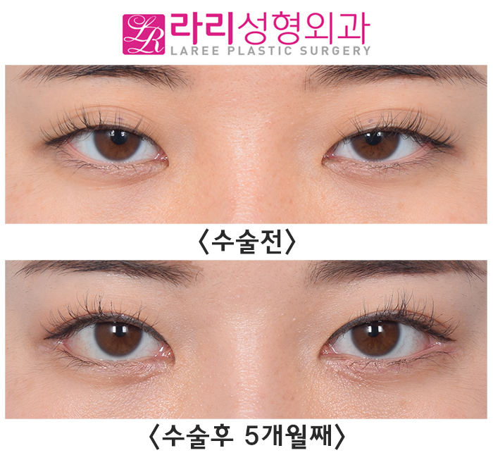 [Rari Plastic Surgery] First Eye Surgery (Non-incisional eyelid correction, epicanthoplasty, canthoplasty) Before-and-After Photos image 1
