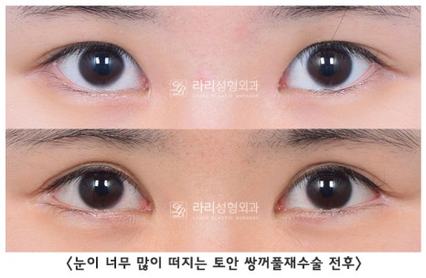 [라리성형외과] 쌍꺼풀수술 그리고 쌍꺼풀재수술 , 성공하려면 어디서 해야 할까요 !? 관련 이미지 8