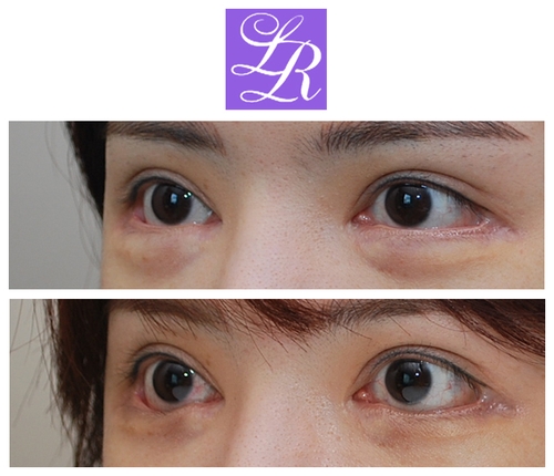 Long-Term Follow-Up Review Confirming the Effect of Lower Canthoplasty image 10