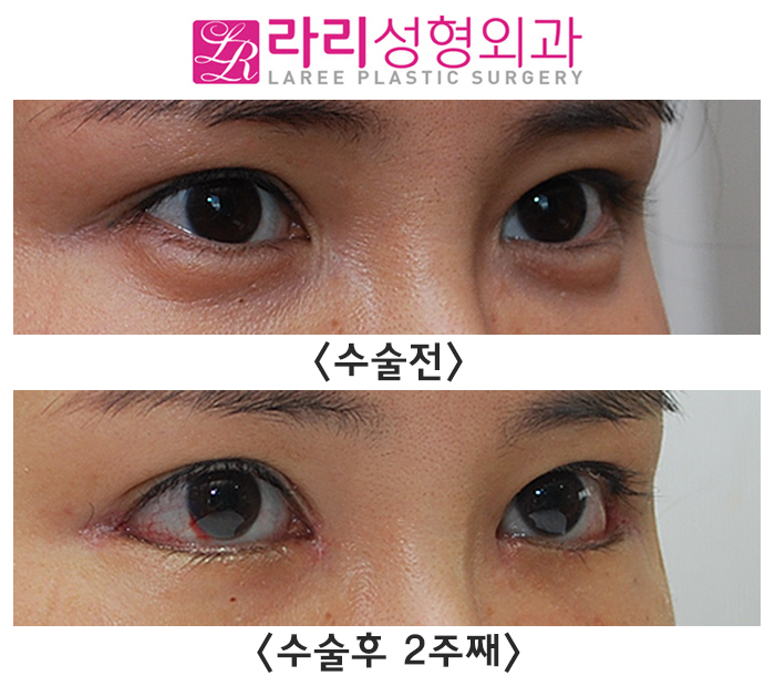 [Rari Plastic Surgery] Medial Canthoplasty Reoperation, Lateral Canthoplasty: Short-Term Progress on the Day of Stitch Removal Before and After Surgery image 3