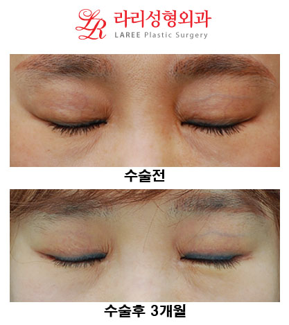 Revision Eyelid Surgery, Cases That Need Ptosis Correction, Correcting Asymmetry in Uneven Eyes image 5