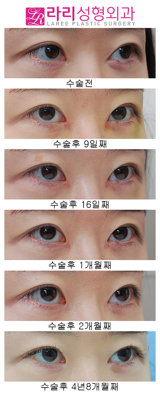 앞트임복원 수술 후 4년8개월 장기경과 관련 이미지 2