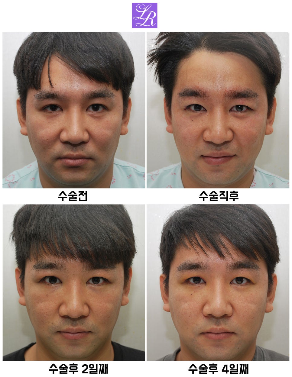 Review of Double Eyelid Reversal Surgery - Day 4 After Surgery, Swelling After Double Eyelid Surgery image 1