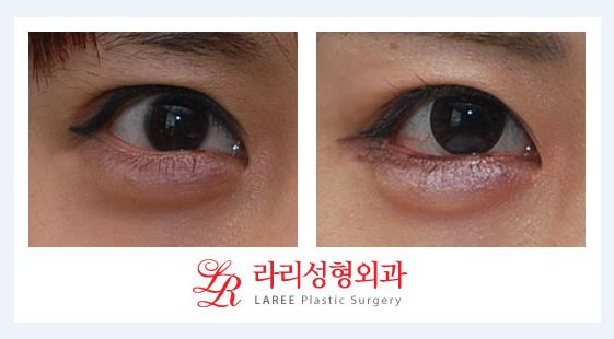 ※What Is the Wise Choice for Double Eyelid Revision Surgery?※ image 4