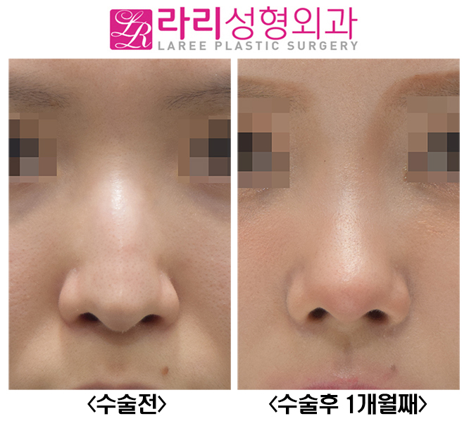 [라리성형외과] 매부리코수술, 무보형물로 자연스럽고 매끈하게 관련 이미지 1