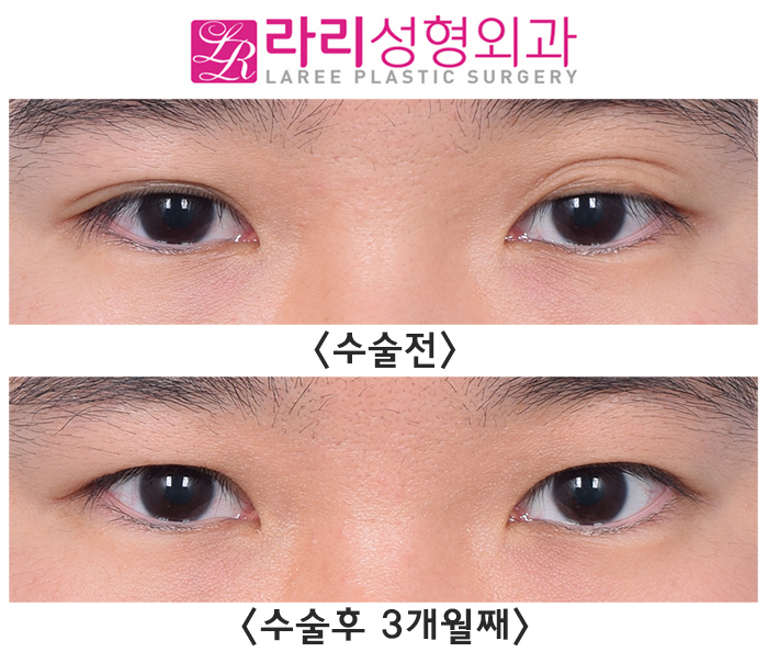 [라리성형외과] 쌍꺼풀 있어도 흐리멍텅한 눈 vs 쌍꺼풀 없어도 똘망똘망한 눈 관련 이미지 2