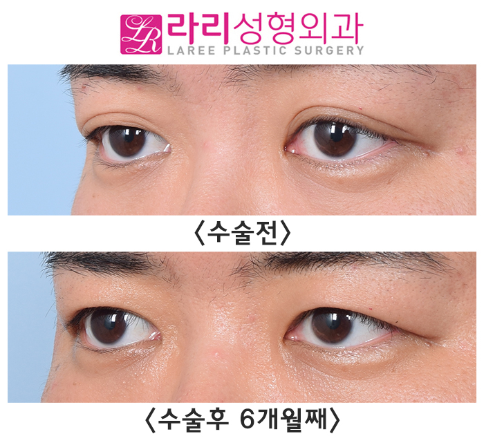 [Rari Plastic Surgery] Difficulty Opening the Eyes, Severe Asymmetry, and Multiple Eyelid Creases: Solved with Crease Removal Surgery! image 2