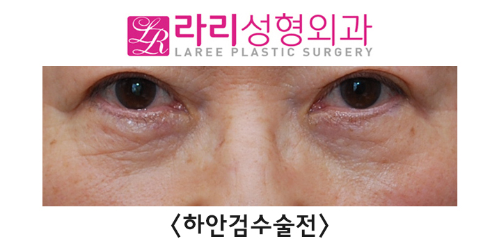 [라리성형외과] 노화로 나타나는 노인성 안검외반의 교정 관련 이미지 2