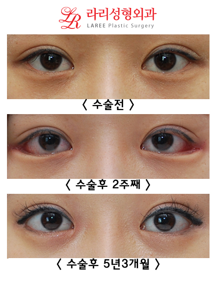 8-Year Long-Term Follow-Up vs. 2-Week Short-Term Follow-Up in the Same Patient (Lateral Canthoplasty & Revision Lateral Canthoplasty) image 1