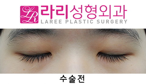[라리성형외과] 절개쌍수 눈매교정 그리고 앞트임 관련 이미지 7