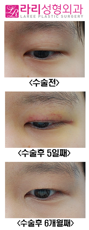 [Rari Plastic Surgery] Thick Natural Double Eyelid Removal Surgery: Before and Up to 6 Months After image 2