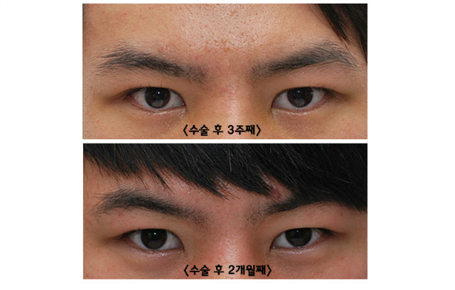 Natural-looking non-incisional eye correction surgery for men with single eyelids is the trend! image 5