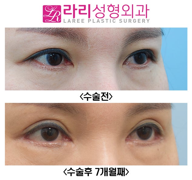 [라리성형외과] 쌍꺼풀재수술로 쌍수라인 높이기와 눈꼬리내리기뒤트임 관련 이미지 2