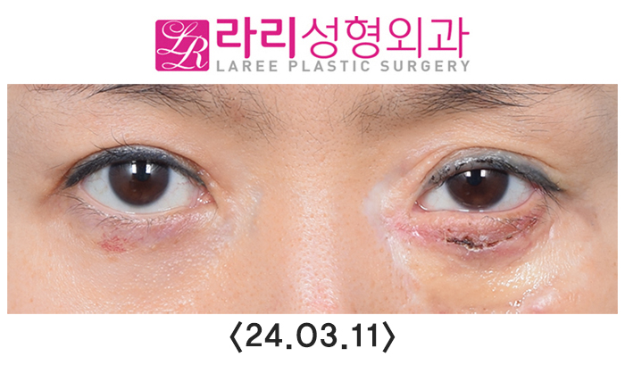 [라리성형외과] 연골이식으로 하안검외반의 일종인 삼백안 교정하기 관련 이미지 5