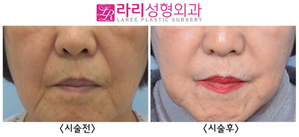 [라리성형외과] 거상수술 없이 필러시술로 팔자주름(+마리오네트주름) 펴주기 (사진 有) 관련 이미지 1
