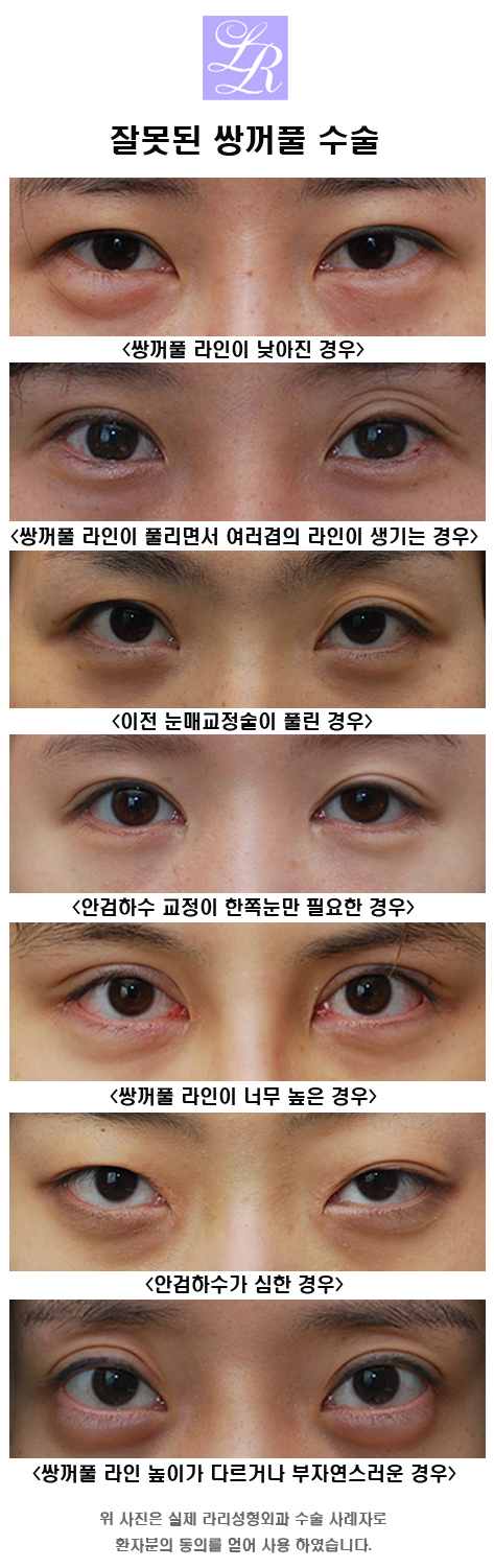 누구나 확인해야할 쌍수재수술후기 관련 이미지 4