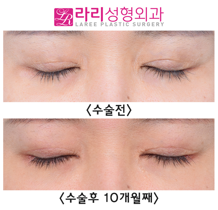 [Lari Plastic Surgery] Sunken Upper Eyelids -> Loop Fat Grafting -> Before-and-After Sunken-Eye Correction Photos image 5