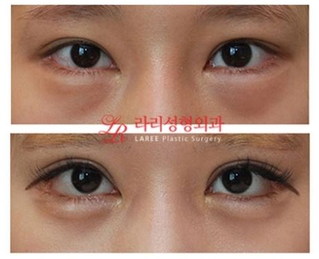 Revision Double Eyelid Surgery, Revision Epicanthoplasty, Under-Eye Fat Repositioning Before and After Photos image 1