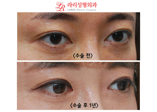 앞트임 복원 전후사진 (수술 2개월후와 1년후) 관련 이미지 6