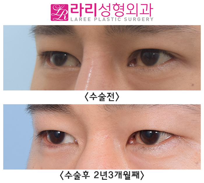 [Rari Plastic Surgery] Removing Double Eyelids Completely / No Double Eyelids When Eyes Are Open, No Double Eyelids When Eyes Are Closed image 3