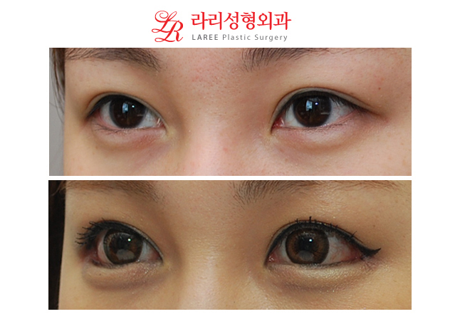 Before-and-After Photos of Eye Corner Lowering Lateral Canthoplasty image 3