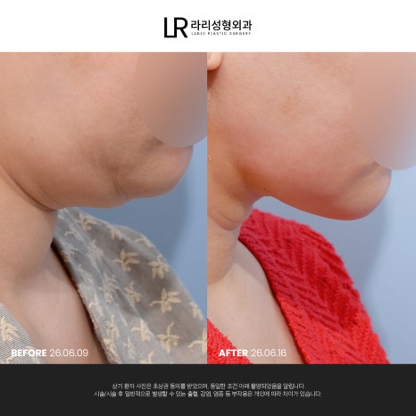 [라리성형외과] 이중턱 지방 흡입만으로는 아쉬운 얼굴 라인, 이중턱 근육 묶기도 같이 하면 효과가 두 배! 관련 이미지 16
