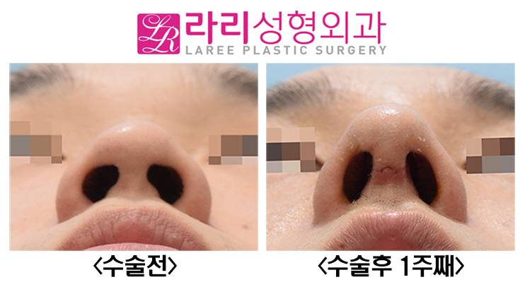 [Lari Plastic Surgery] Before-and-After Photos of Male Rhinoplasty with Rib Cartilage image 6