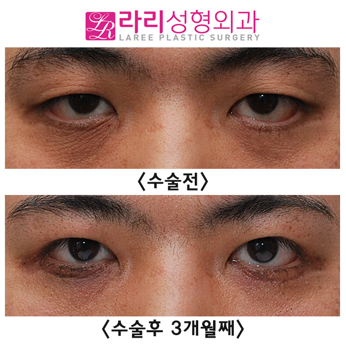 [Rari Plastic Surgery] Eyelid Ectropion Correction Surgery Methods According to Eye Condition image 1
