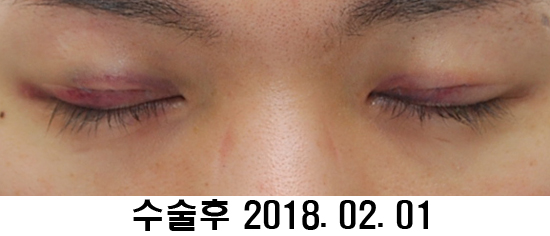 Before and After: Sharper Male Eye Correction (feat. Video) image 5