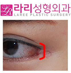[라리성형외과] 뒤트임재수술,결막이식으로 뒤트임부작용(물갈퀴변형, web deformity) 교정하기 관련 이미지 1