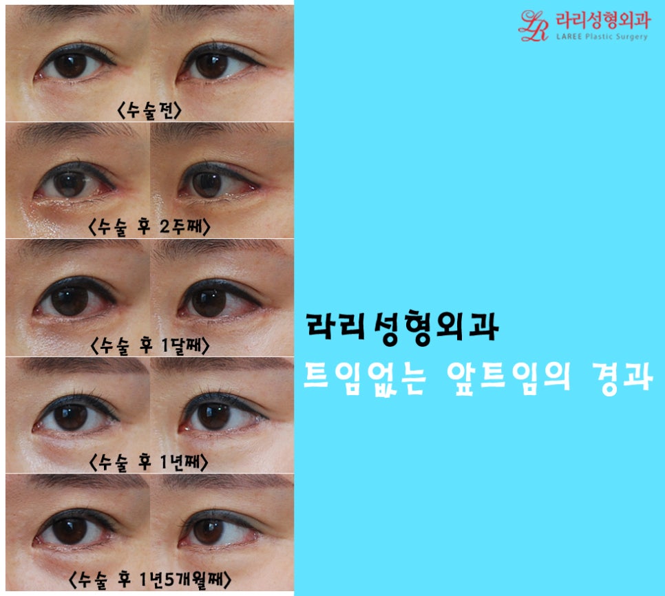 몽고주름, 더이상 헤매지말고 트임없는앞트임으로! 관련 이미지 7
