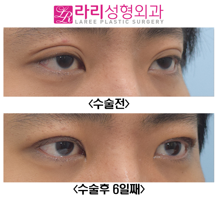 [라리성형외과] 남자 졸려보이는눈 눈매교정 수술 전후 관련 이미지 3