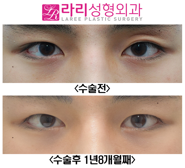 [라리성형외과] 쌍꺼풀없애기와 앞트임수술 전후사진 관련 이미지 1