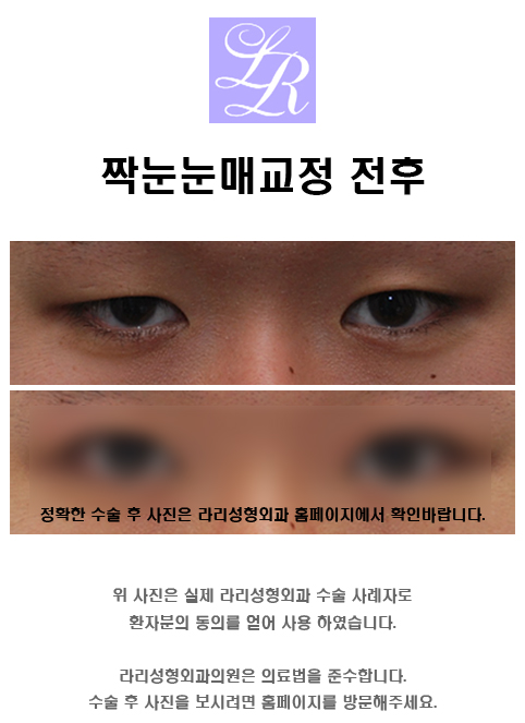 Where Is a Good Place for Eye Correction for Uneven Eyes? image 4