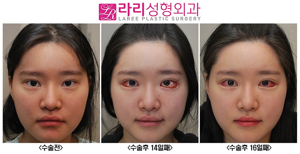 [Rari Plastic Surgery] About Conjunctival Edema After Canthoplasty.. (Causes and Management) image 1