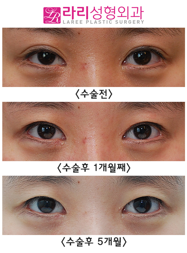 [라리성형외과] 쌍꺼풀없애는수술로 눈매교정과 짝눈교정을 한번에 (겉쌍에서 속쌍, 무쌍으로의 변화) 관련 이미지 1