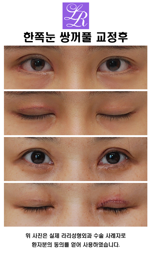 Double Eyelids, Especially When One Eye Has a Double Eyelid image 4