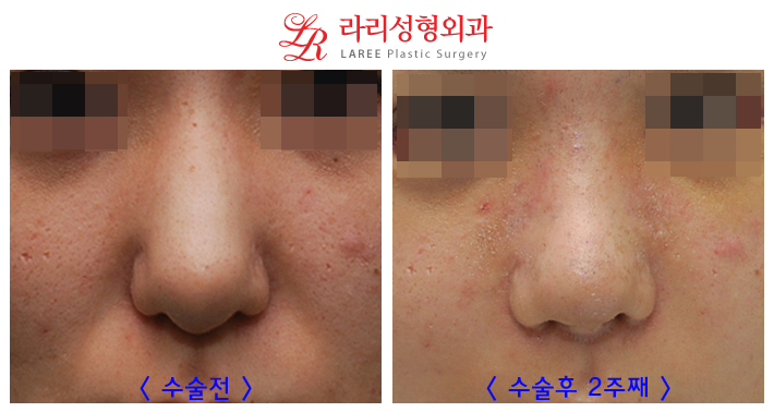 코재수술 잘하는곳 변화가 확실한 라리성형외과! 관련 이미지 3
