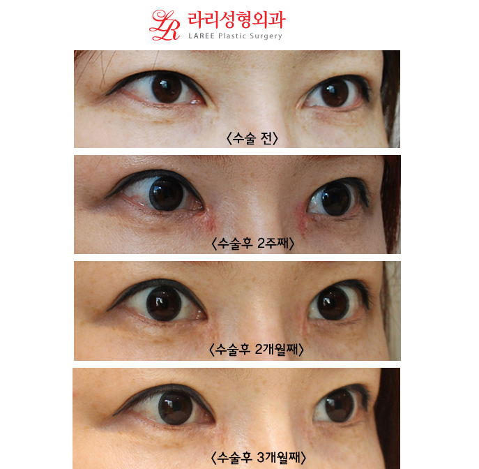 The Standard of Epicanthoplasty Restoration/Epicanthoplasty Reconstruction/Mongolian Fold Restoration/Mongolian Fold Reconstruction: 3D Epicanthoplasty Restoration Before-and-After Photos image 3