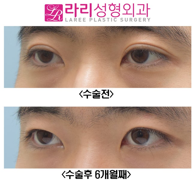 [Rari Plastic Surgery] Eliminating Thick Double Eyelids with a Near-No-Double-Eyelid Inner Fold image 4