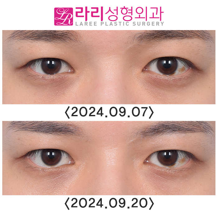 [라리성형외과] 이마보톡스가 눈 모양이나 쌍꺼풀 라인에 미치는 영향에 대하여 관련 이미지 3