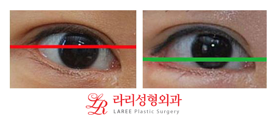 뒤트임/뒷트임 사진 후기 정보☆ 관련 이미지 5