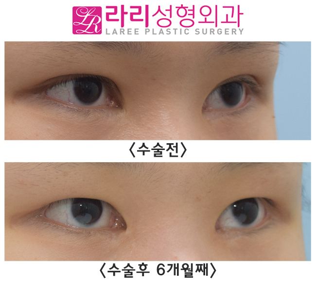 [라리성형외과] 함몰눈의 쌍꺼풀없애기 수술 전후 관련 이미지 2